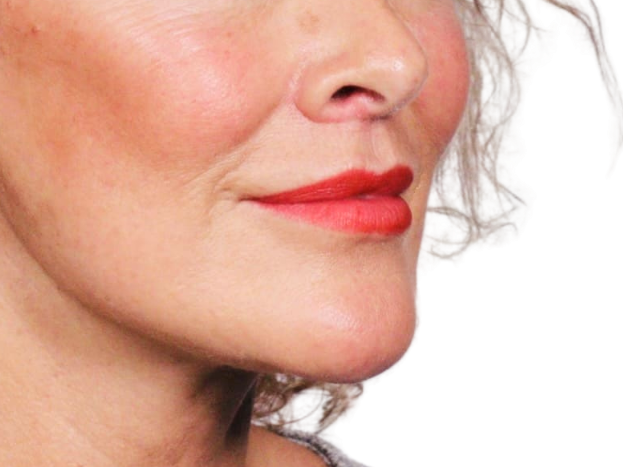 The Benefits of Lip Lift Surgery