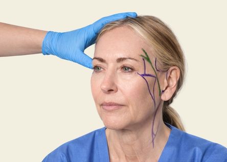 What is Face & Neck Lift?