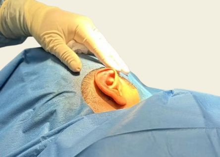 What is Otoplasty?