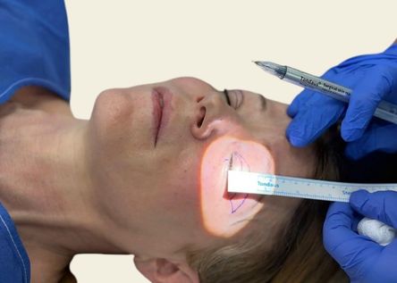 What is Blepharoplasty?