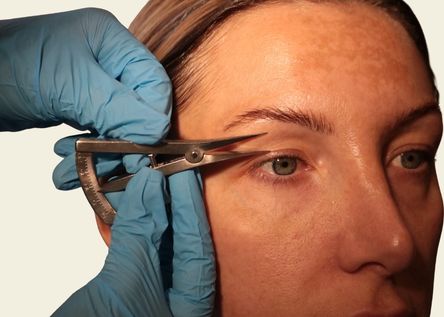 Is Blepharoplasty right for you?