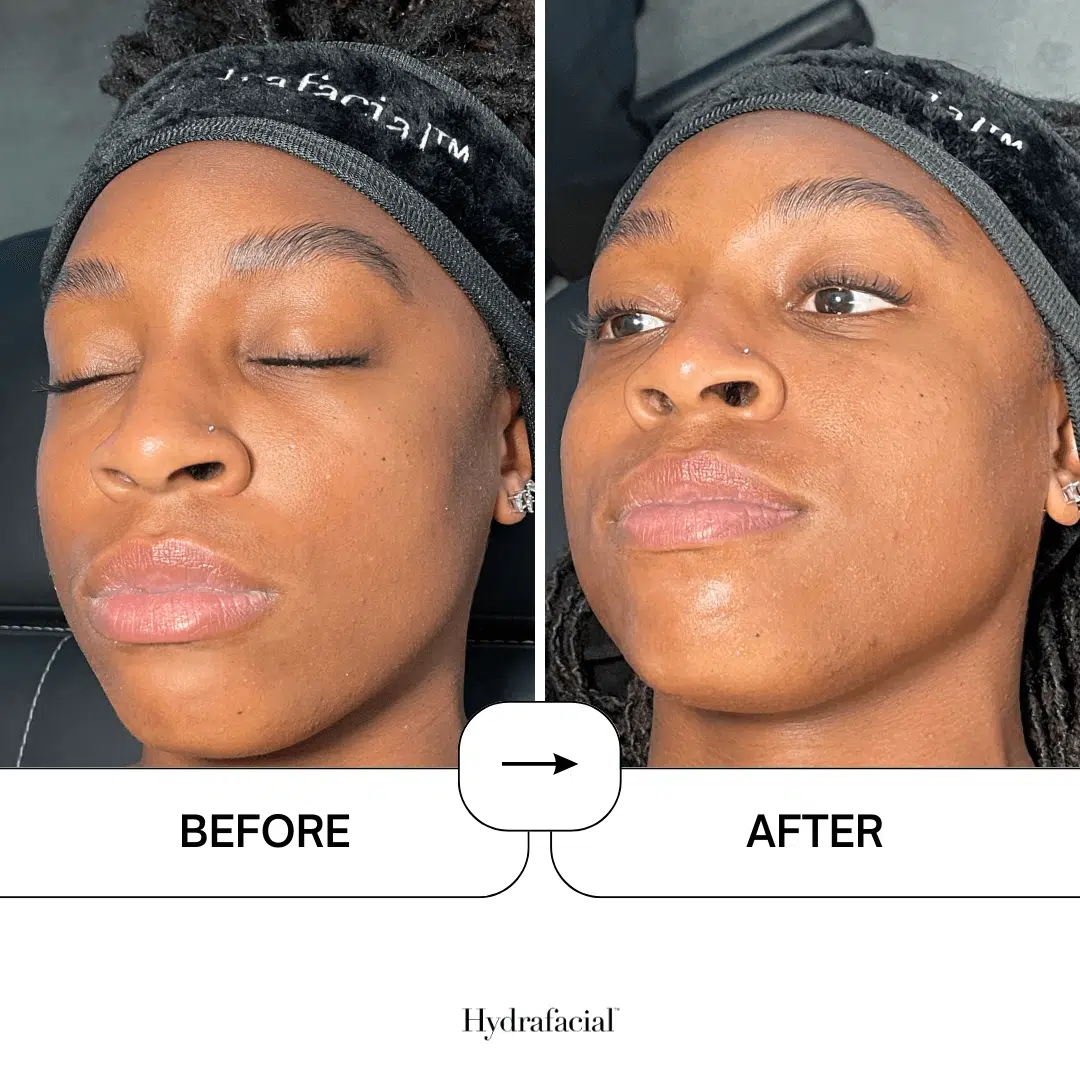 Hydrafacial result 1