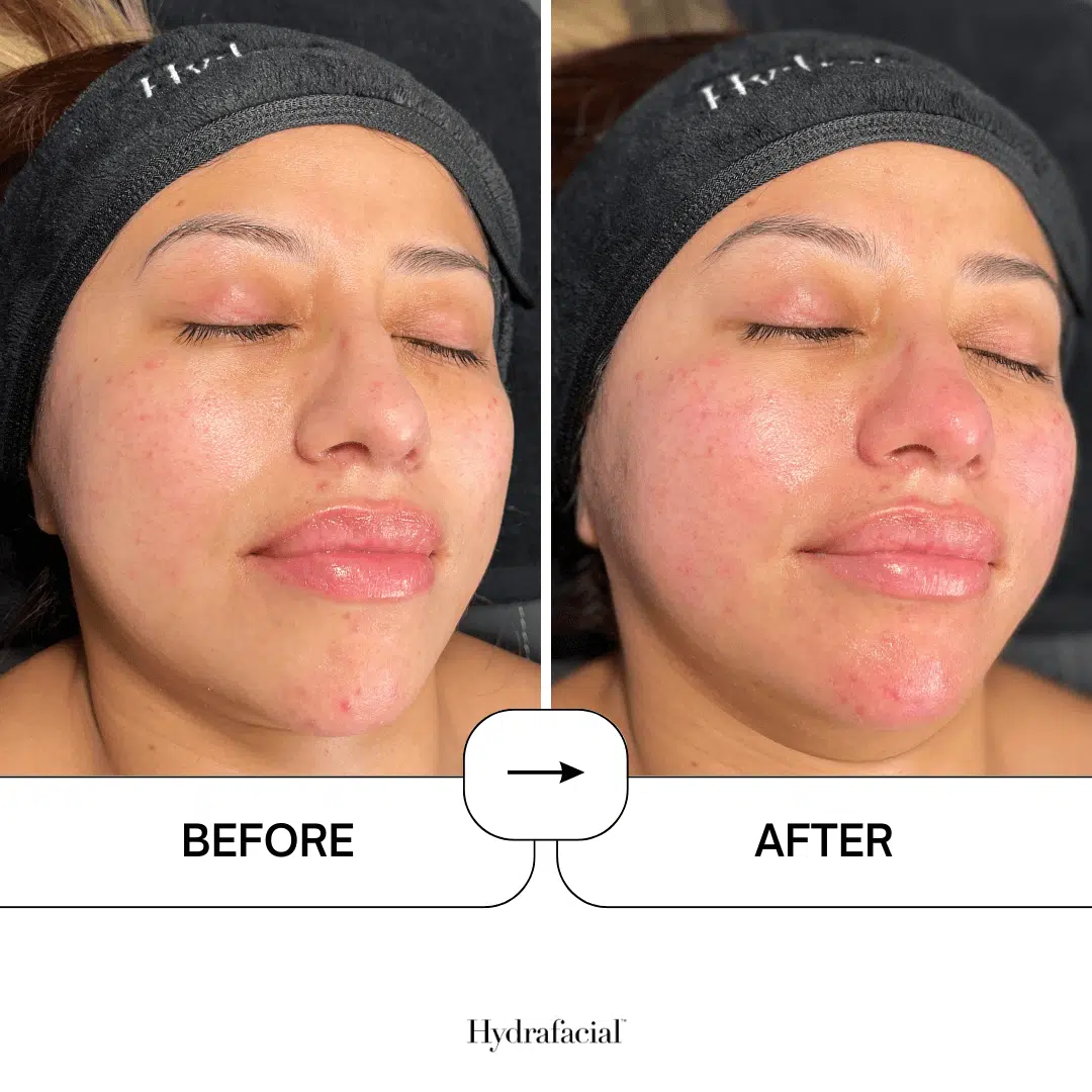 Hydrafacial result 2