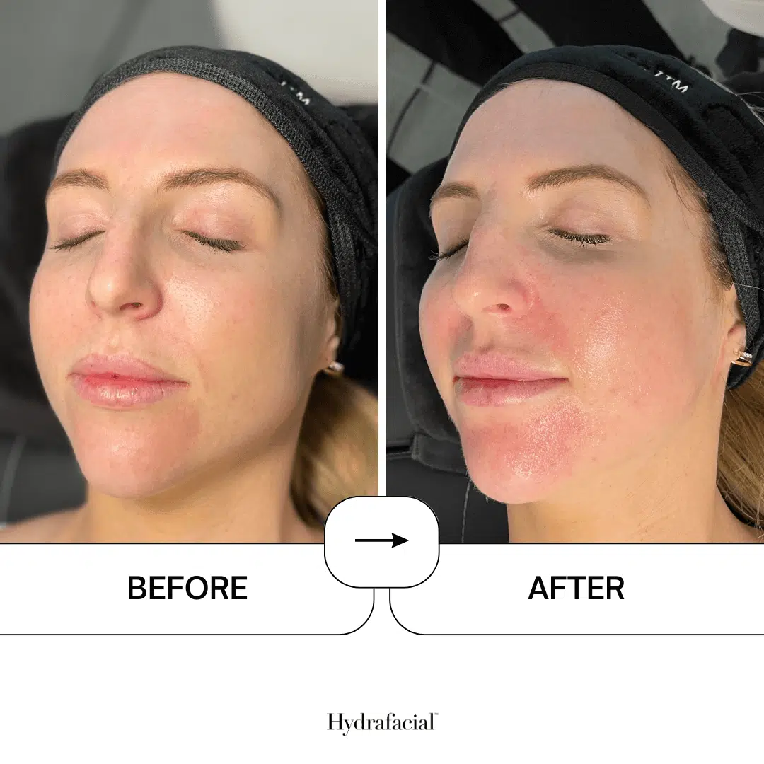 Hydrafacial result 3