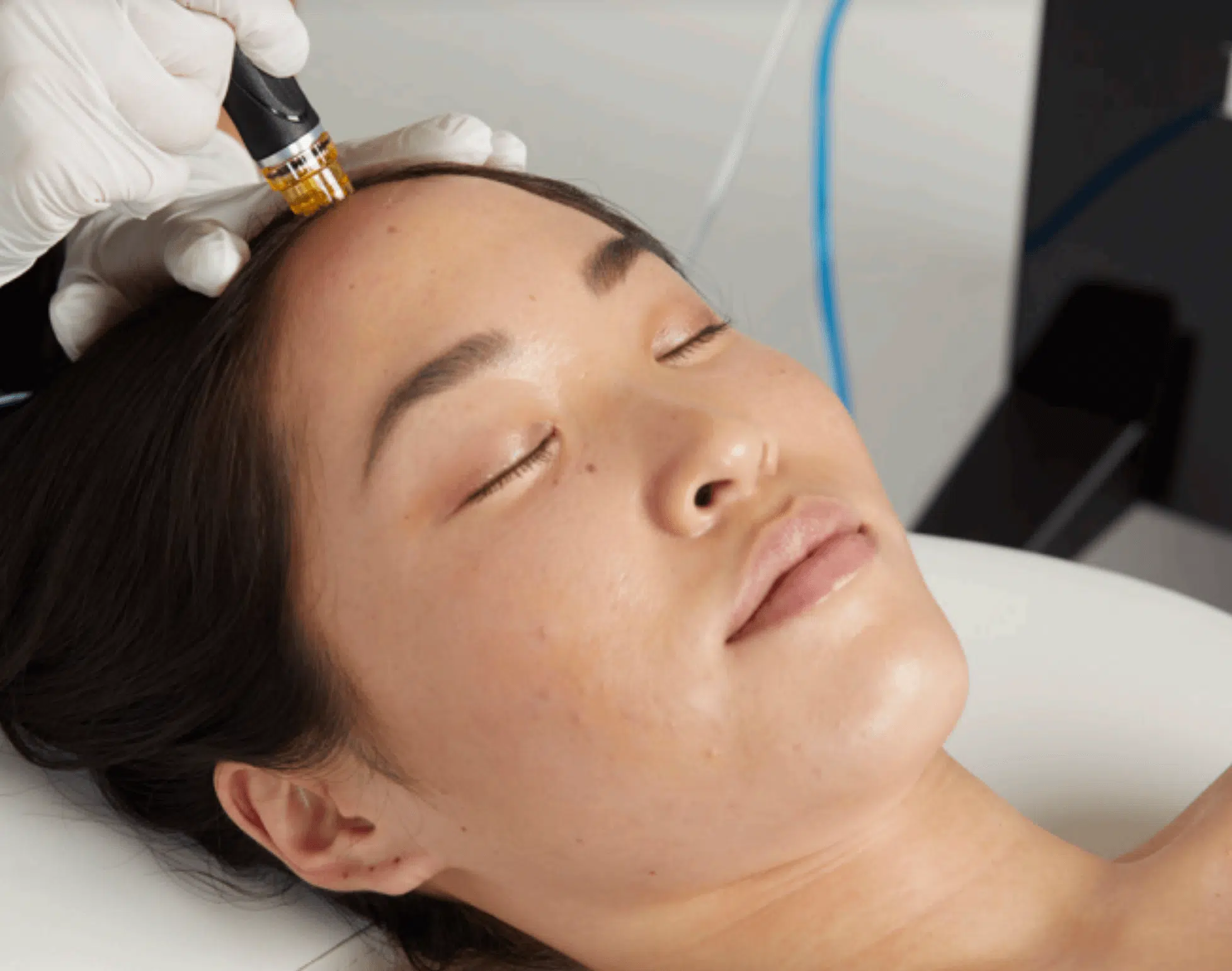 Key Benefits of Rhinoplasty York