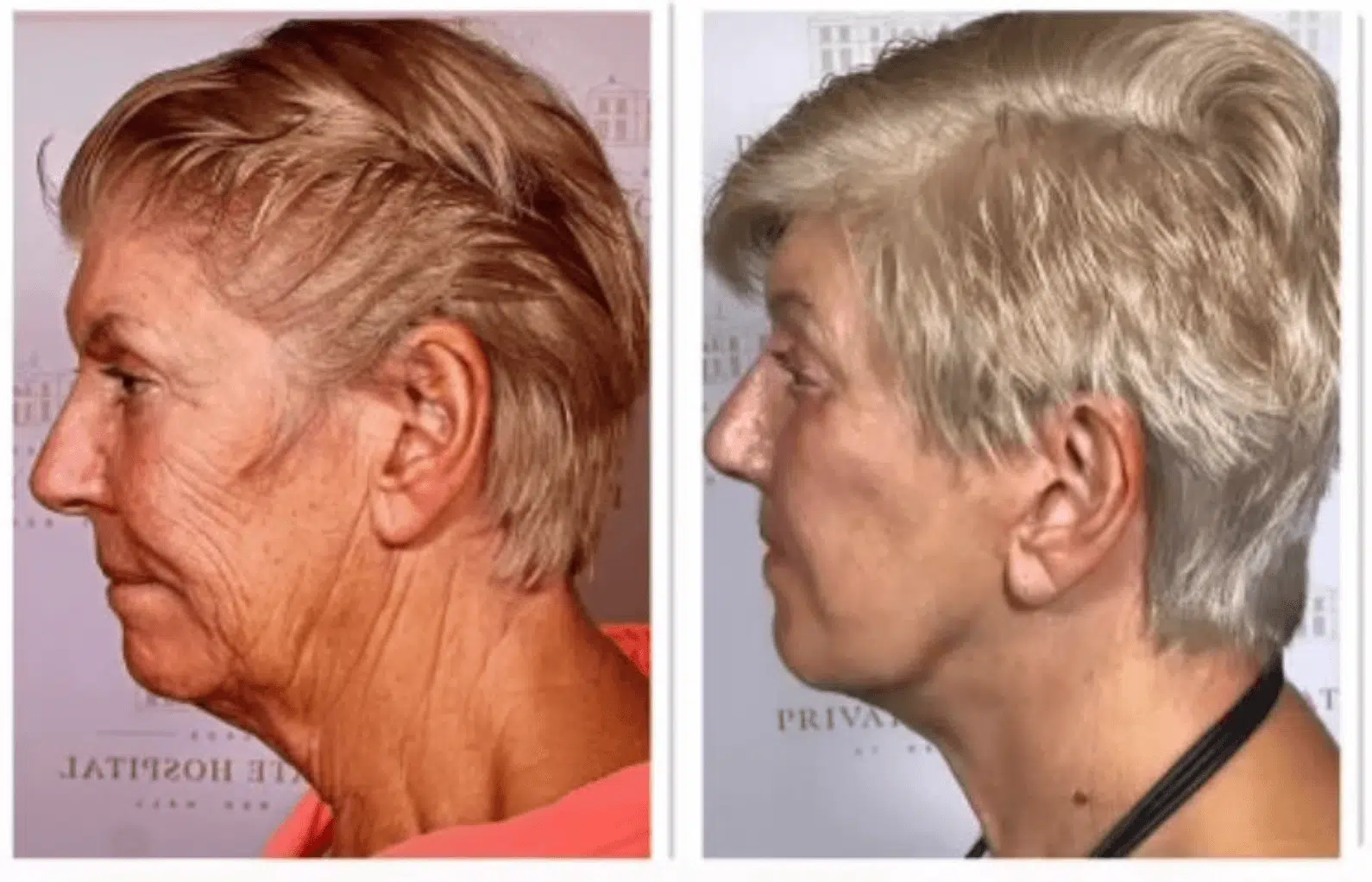 Hydrafacial result 1