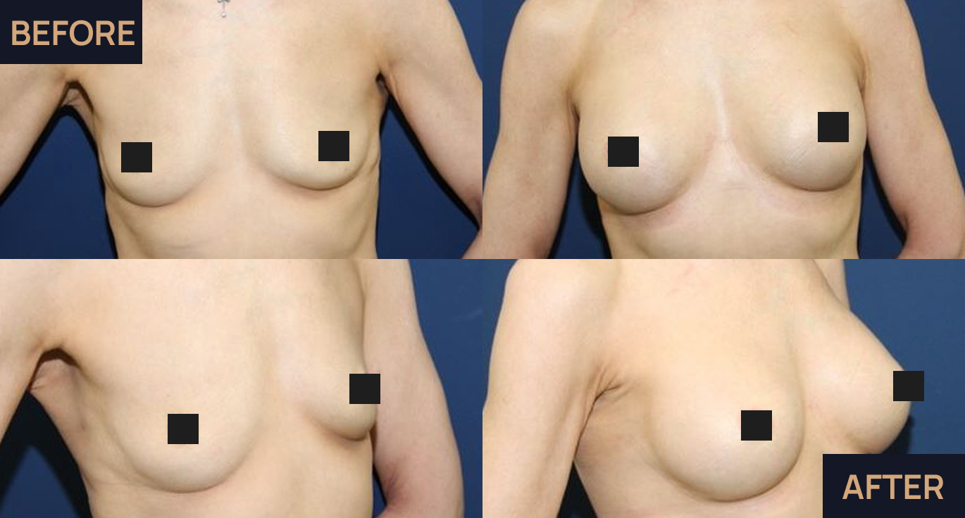 Breast augmentation image 1