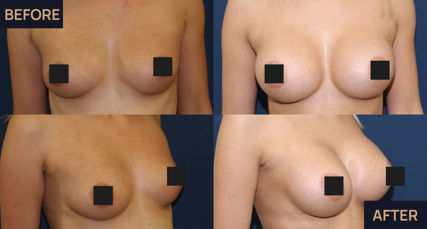 Breast augmentation image 2