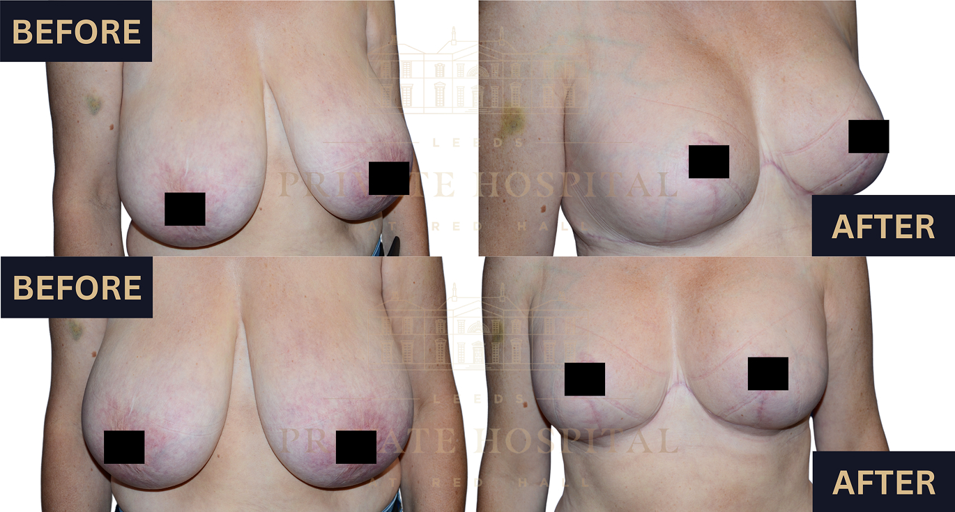 Breast augmentation image 3