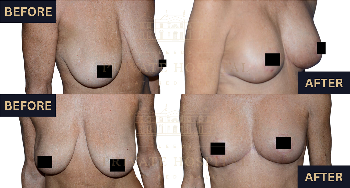 Breast augmentation image 4