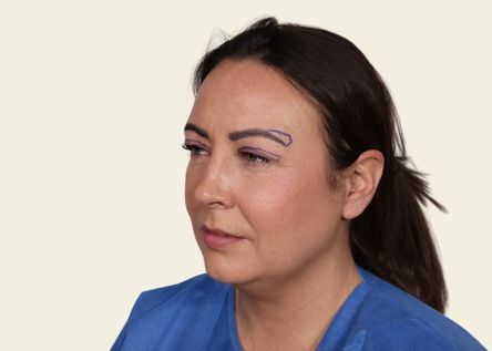 What Can a Brow Lift Improve?