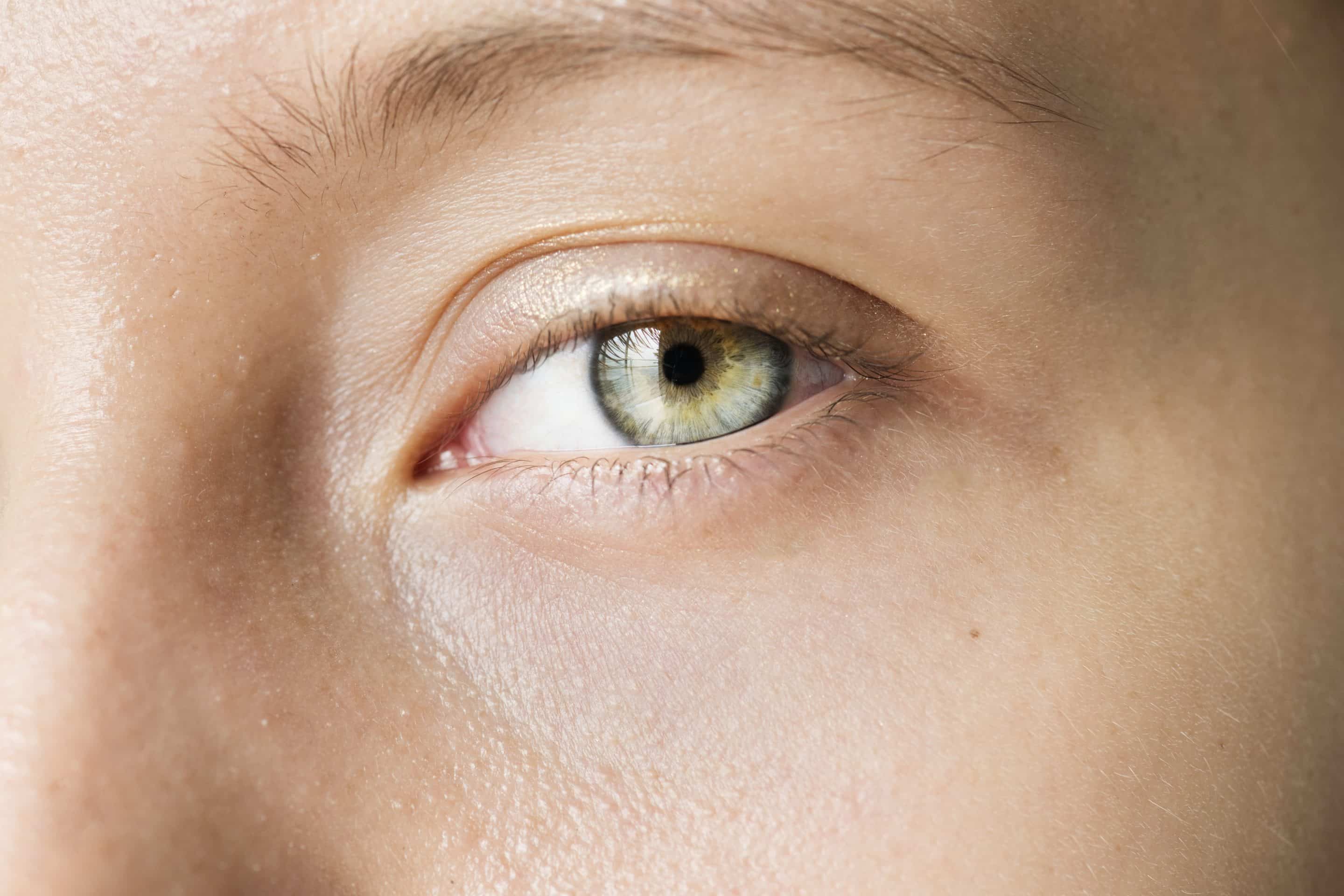 Xanthelasma: What It Is, Causes and Treatment