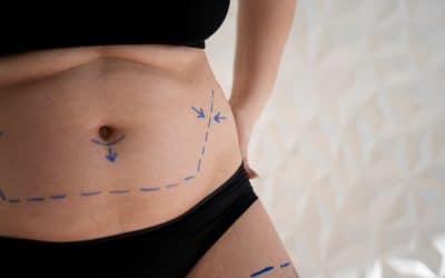 Liposuction for Different Body Areas: Targeting Stubborn Fat